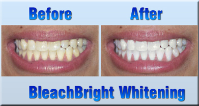 teeth whitening new bedford.jpg